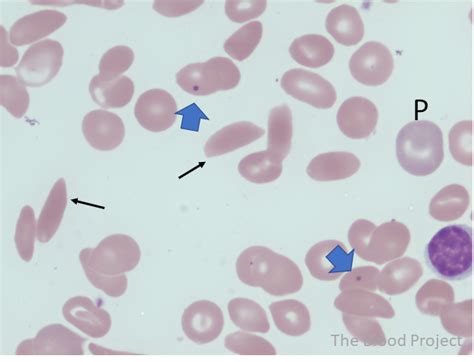 Sickle Cells • The Blood Project
