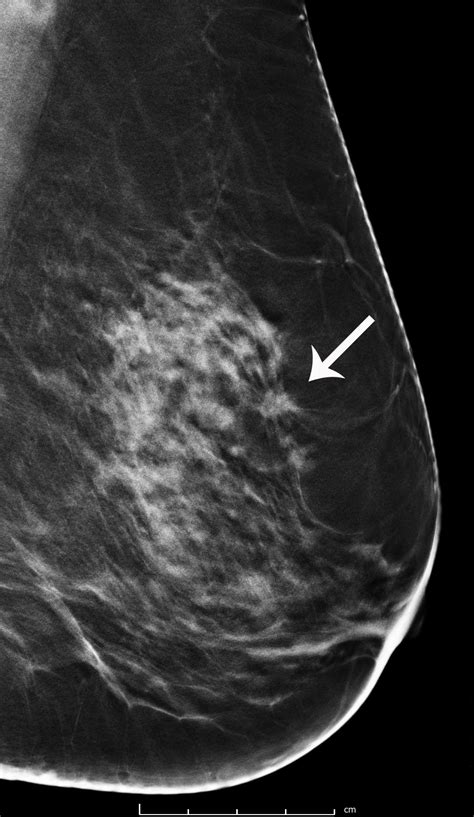 What does breast cancer look like on a mammogram? Breast Cancer Screening with 3D Mammography or ...