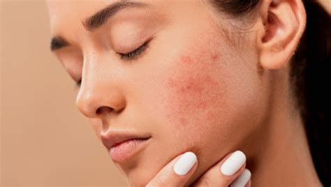 Beauty Tips How To Manage Dry Skin With Acne Healthshots