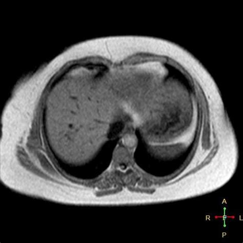 Horseshoe Kidney With Hypoplastic Left Lobe Radiology Case