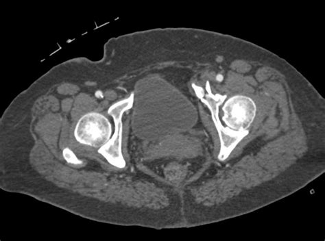 Fractured Aneurysmal Bone Cyst Femur Musculoskeletal Case Studies