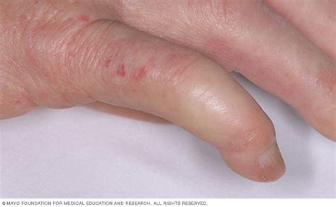 Limited Scleroderma Symptoms And Causes Mayo Clinic