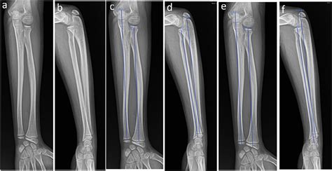 Frontiers Characteristics Of The Length Of The Radius And Ulna In