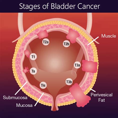 Symptoms of advanced bladder cancer. Spectrum Pharmaceuticals, Inc.- Product Portfolio - Late ...