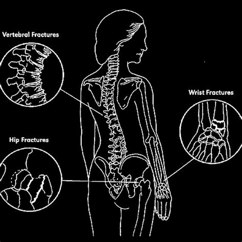 3 Common Fractures In Osteoporosis Download Scientific Diagram