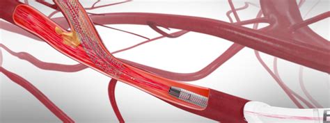 New Stent Surgery For Carotid Arteries