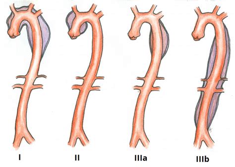 Aortic Dissection Classification Management Teachmesurgery