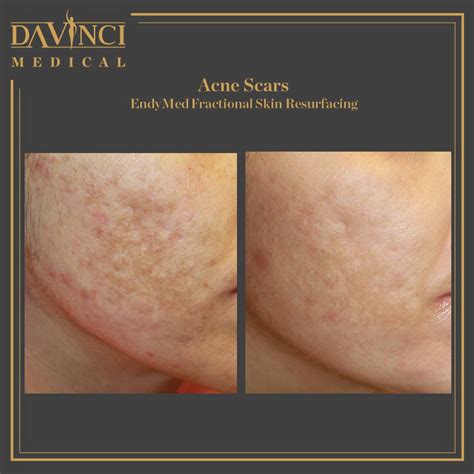 Da Vinci Clinic Acne Scars Treatment Using Rf Microneedling