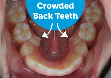 So, my teeth are already crooked, what can i do to straighten them? and my teeth are pretty straight but i feel them shifting. Crowded Back Teeth • Smile Logic Orthodontics • South ...