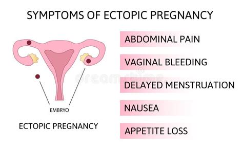 Ectopic Pregnancy Locations