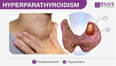 Hyperparathyroidism Types Causes Syptoms And Its Treatments