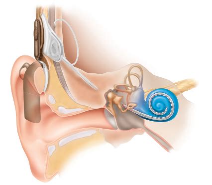 Lippy Surgery Center Warren OH Implants For Hearing Loss And Deafness