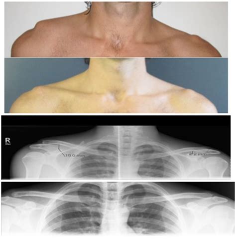 Clinical Effect Of Acute Complete Acromioclavicular Joint Dislocation