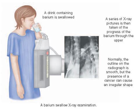Barium meal examinations are used to study the lower esophagus, stomach and duodenum under fluoroscopic control. Experience : Barium Swallow X-ray - Beeha Azman