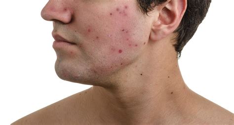 Acne Scars And Keloids In The Face Of A Man Keenanfrith Flickr