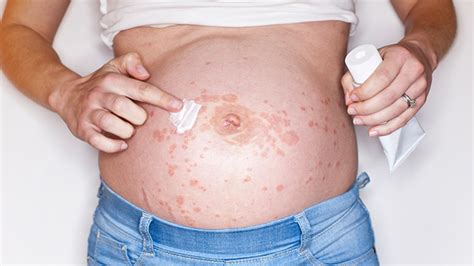 Skin Rash Pupp During Pregnancy What To Expectpush