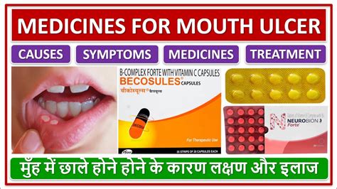 Medicines For Mouth Ulcer Treatment Management मुँह में छाले होने
