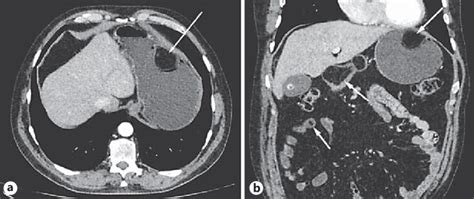 Abdominal Ct Demonstrated A Round Sharply Contoured Polypoid Lesion