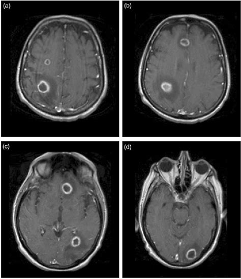 Brain Lesions Mri