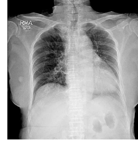 Figure From Misdiagnosis Of Hemothorax As Atelectasis After Minimally