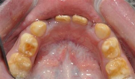 Multiple Brownish Discoloration Of Maxillary Primary Dentition