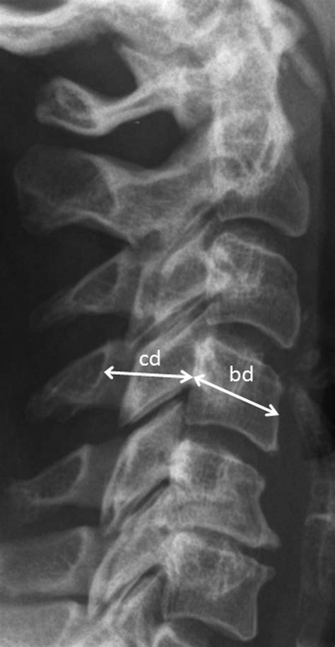 Conventional Lateral Radiograph Of The Cervical Spine With The
