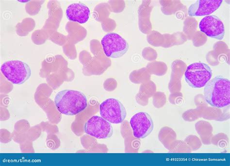 Lymphoblast Stock Photo Image Of Leukocyte Microbiology 49323354