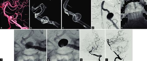 A 3d Rotational Angiography And Digital Subtraction Angiography
