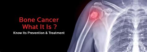 Bone Cancer All You Need To Know Cmri