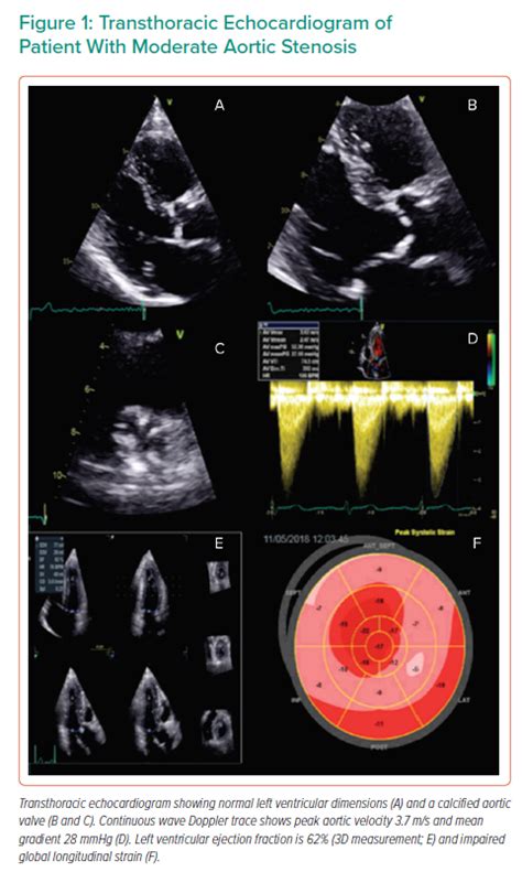 Transthoracic Echocardiogram Of Patient With Moderate Aortic Stenosis Radcliffe Cardiology