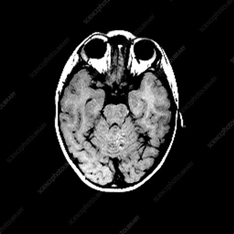 Childs Brain Mri Scan Stock Image P3320511 Science Photo Library