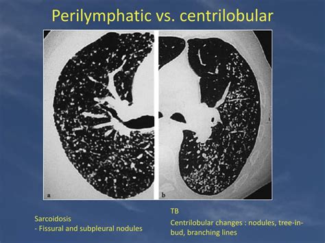 Ppt Lung Nodules Powerpoint Presentation Free Download Id2372940