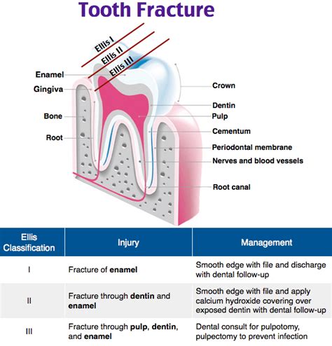 Tooth Fracture Ellis Classification I Fracture Grepmed