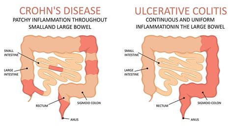 Digestive Health 101 Cant Ignore That Gut Feeling