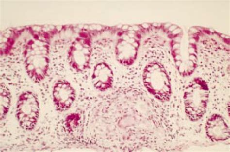 High Power Photomicrograph Of Mucosal Biopsy Specimen Twin Stained