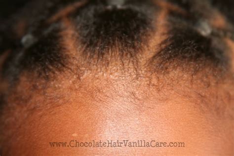 Stress Bumps Along Boos Hairline They Are Little White Bumps That