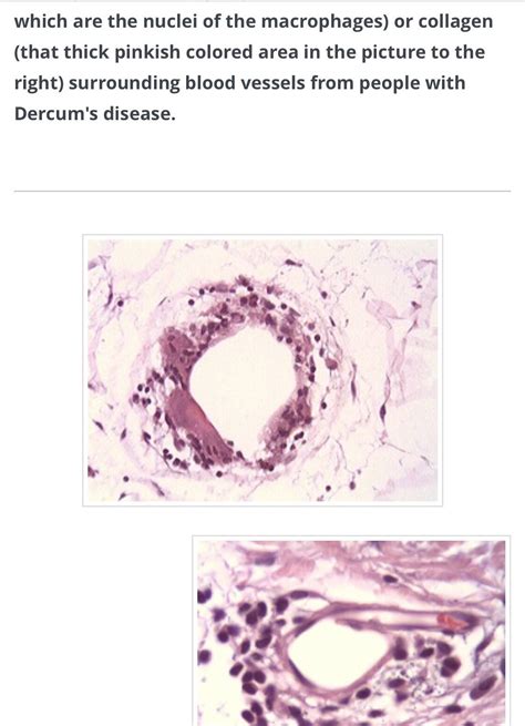 Pin On Zebra Dercums Disease