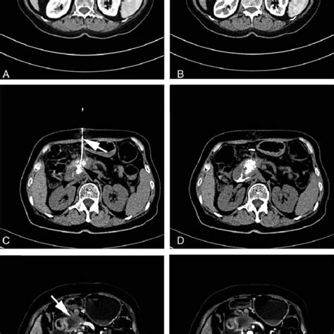 Preoperative And Postoperative Computed Tomography Ct Scans A B
