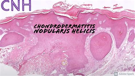 Chondrodermatitis Nodularis Helicis Cnh 5 Minute Pathology Pearls