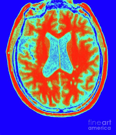 Multiple Sclerosis Brain Mri Photograph By Dr W Crum Dementia