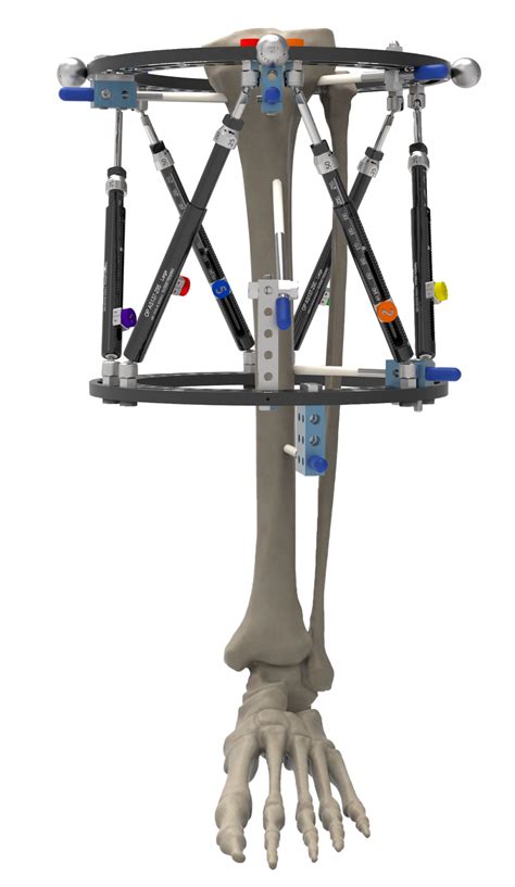 Orthex Small Bone Circular Fixator Orthopediatrics