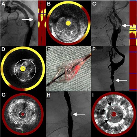 Composition Of Carotid Artery Stenosis And Restenosis A Series Of