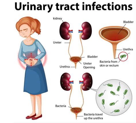 Best Natural And Home Remedies For Urinary Tract Infection Uti