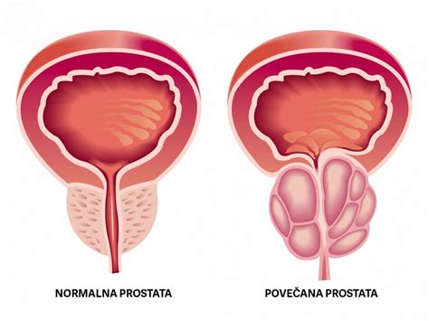 Rak Prostate Kaj Mora Mo Ki Vedeti O Prostati Zdravje