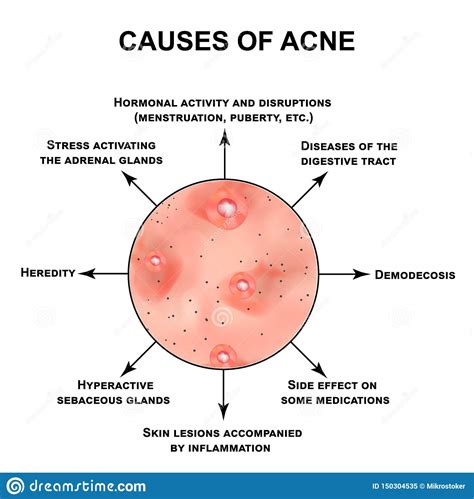 Causes Of Acne Pustules Papules Comedones Blackheads Acne On The