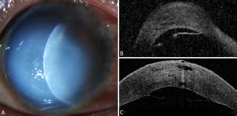 Acute Corneal Hydrops Ophthalmology