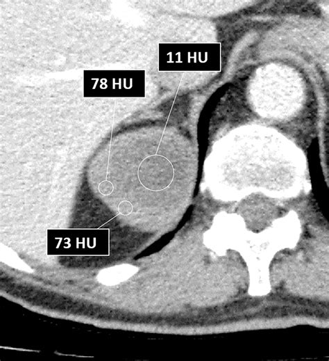 Bosniak Classification Of Cystic Renal Masses Version A Pictorial Guide To Clinical Use