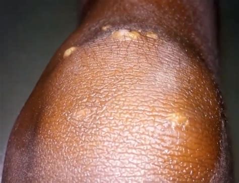 Recurring Boils On Inner Thigh Archives New Pimple Popping Videos