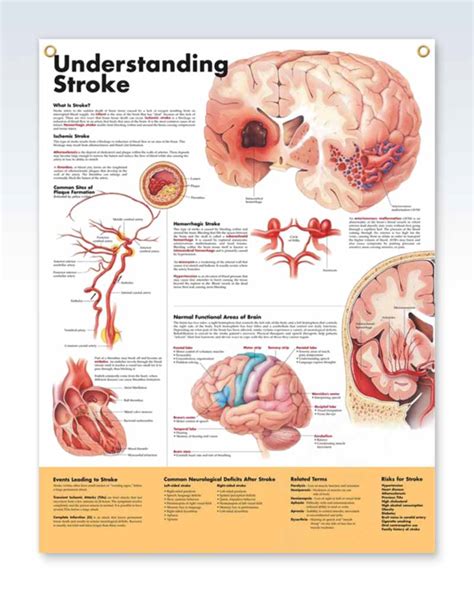 Understanding Stroke Exam Room Anatomy Poster Clinicalposters