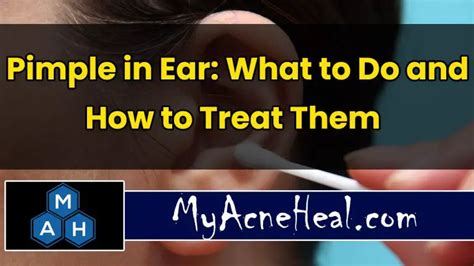 Pimple In Ear What To Do And How To Treat Them